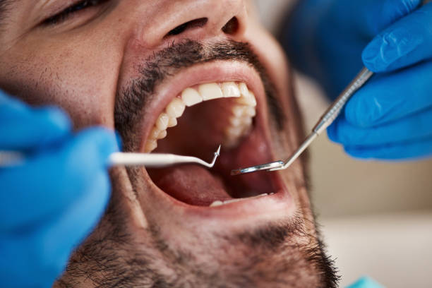 Best Knocked-Out Tooth (Avulsed Tooth) Treatment in Wilkshire Hills, OH